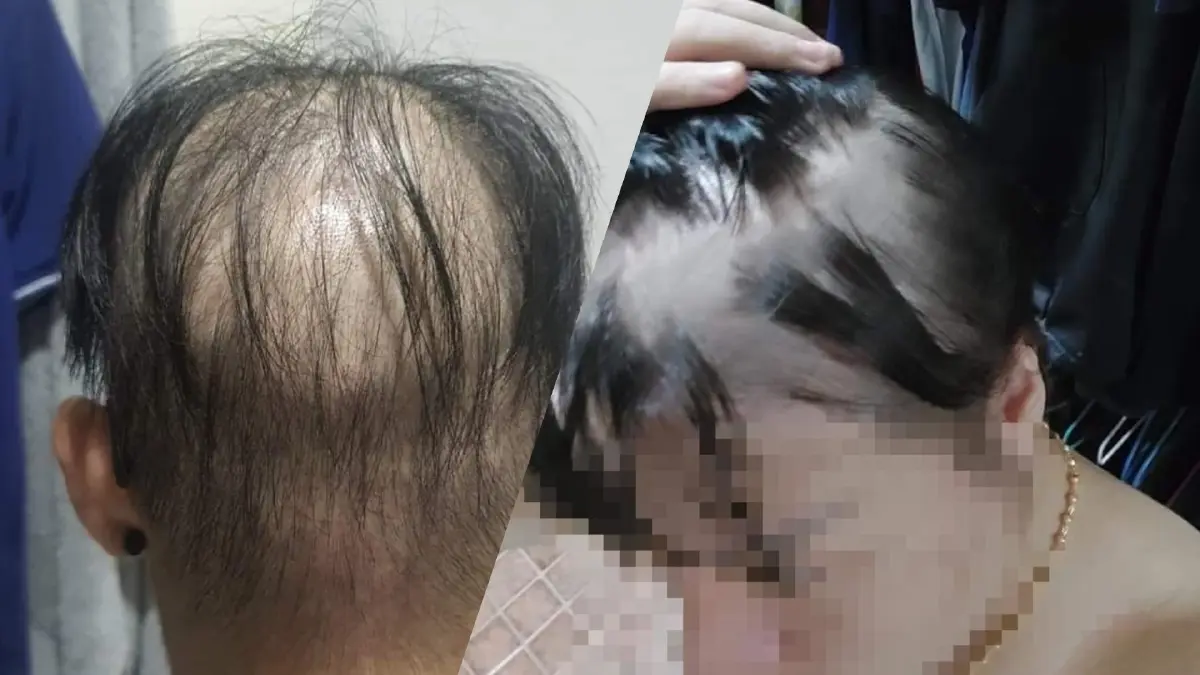 โผล่อีกเพียบ! ฉีดวัคซีนโควิดแล้ว "ผมร่วง" หวังภาครัฐช่วยเหลือ โผล่อีกเพียบ! ฉีดวัคซีนโควิดแล้ว "ผมร่วง" หวังภาครัฐช่วยเหลือ