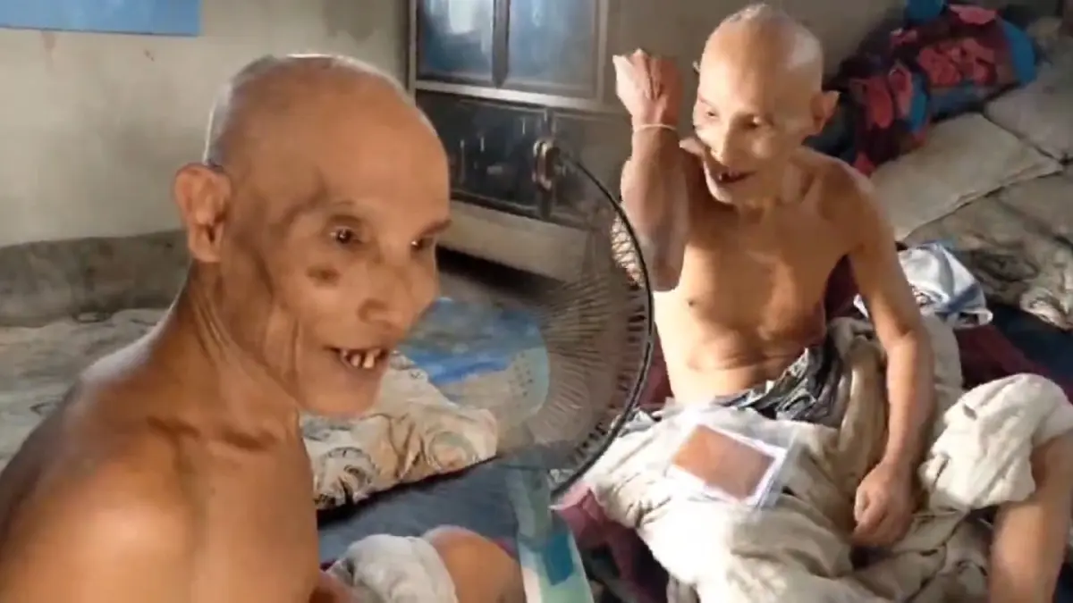 สุดดีใจ!ลุงป่วยติดเตียงนาน 4 ปี ฉีดแอสตร้าฯเข็มแรก ขาเริ่มขยับได้ สุดดีใจ!ลุงป่วยติดเตียงนาน 4 ปี ฉีดแอสตร้าฯเข็มแรก ขาเริ่มขยับได้