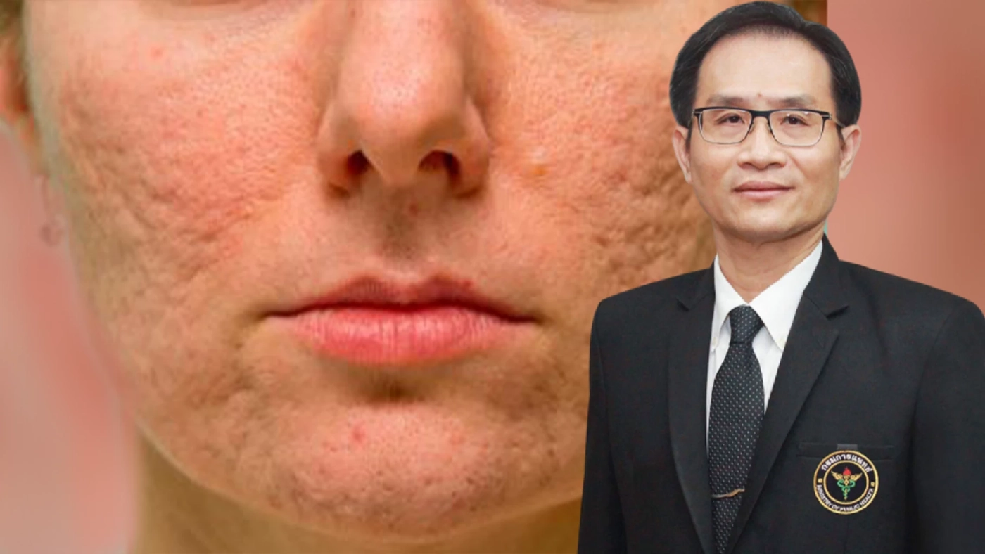 แพทย์ผิวหนังแนะวิธีการรักษาแผลเป็นหลุมสิว