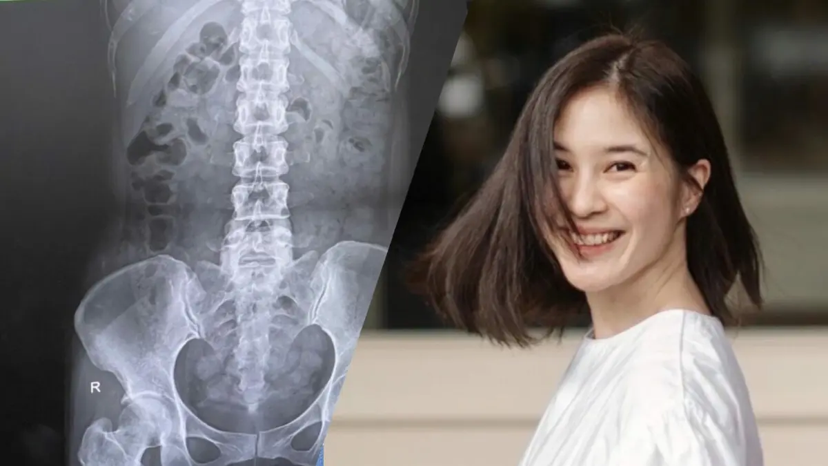 เช็กด่วน! โรคขี้เต็มท้อง ชาวเน็ตฮือฮาแห่สำรวจตัวเอง หมอชี้สุดอันตราย