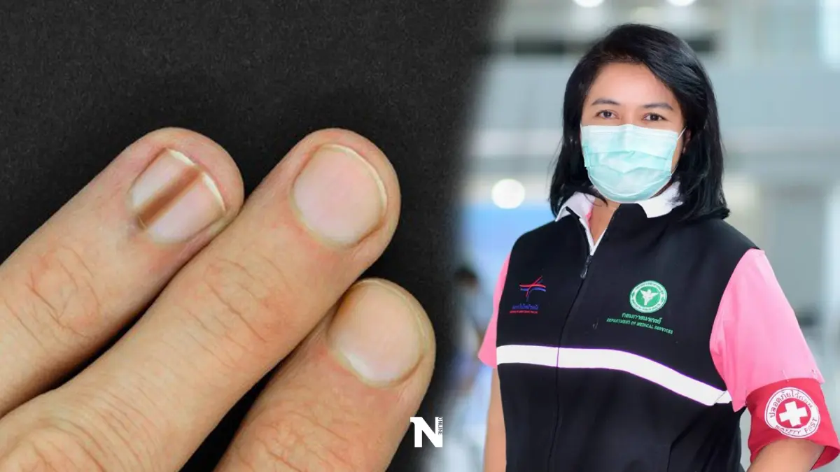 แพทย์เตือนอย่าประมาท "ขีดบนเล็บ" อาจเป็นสัญญาณเตือน "มะเร็งผิวหนัง"