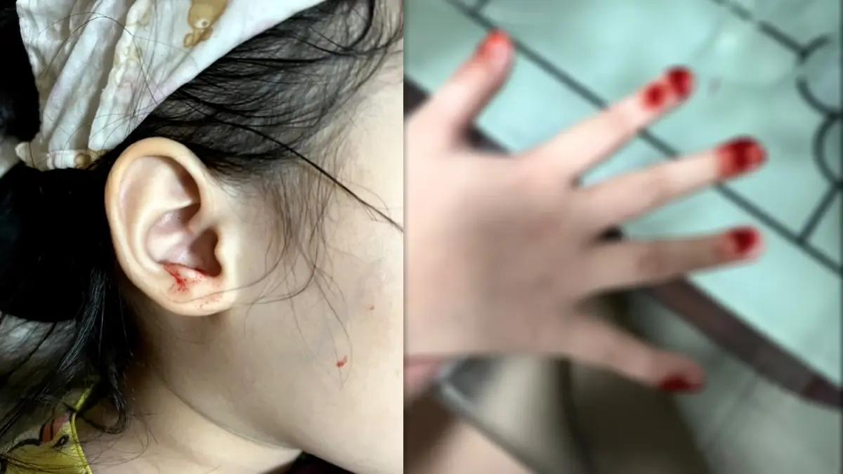 แม่ร้องลูก 7 ขวบหลังฉีดวัคซีนเลือดออกตามผิวหนังทั่วร่างกาย