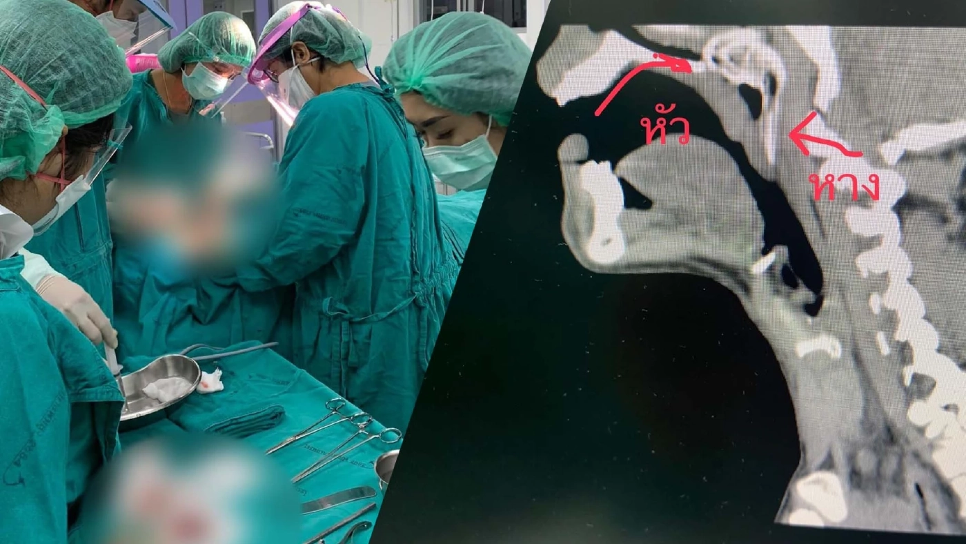 สยอง !! "ปลาหมอ" เข้าปากติดลำคอคนหาปลา แพทย์โรงพยาบาลพัทลุงช่วยผ่าจนรอดตาย