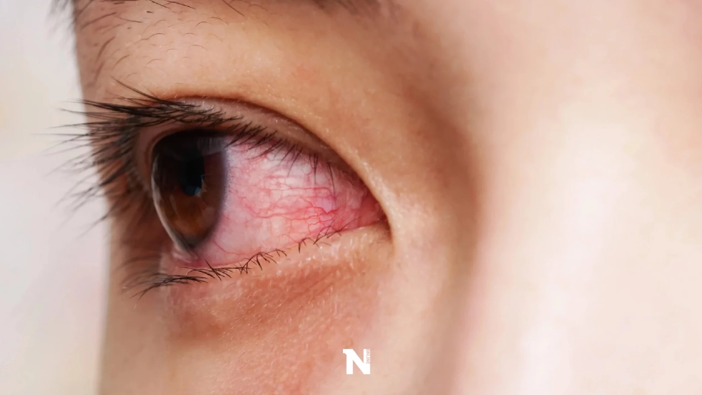 หมอเตือน ระวัง"โรคตาแดง" พบระบาดหนักในช่วงหน้าฝน