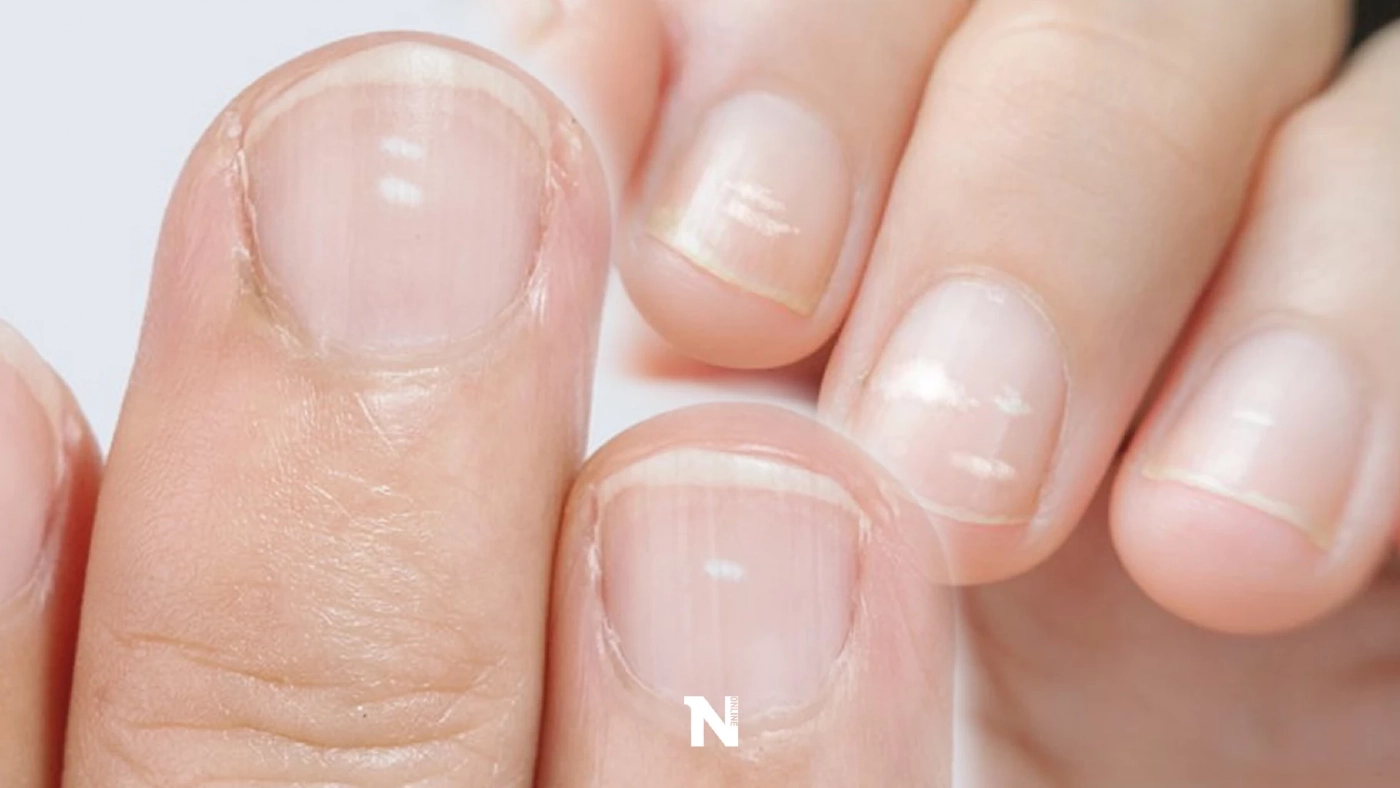 ไขคำตอบ "รอยจุดสีขาวบนเล็บ" คืออะไร อาการแบบไหนต้องไปพบแพทย์