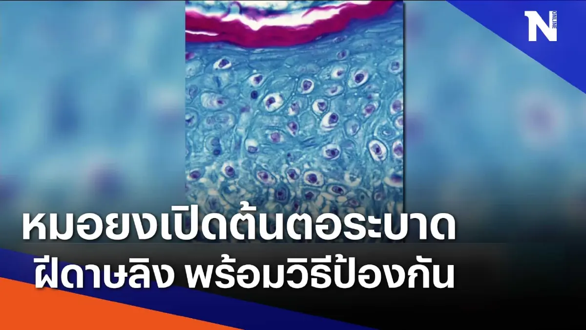 "หมอยง" เปิดต้นตอระบาด "ฝีดาษลิง" พร้อมวิธีป้องกัน | เนชั่นทันข่าวเช้า