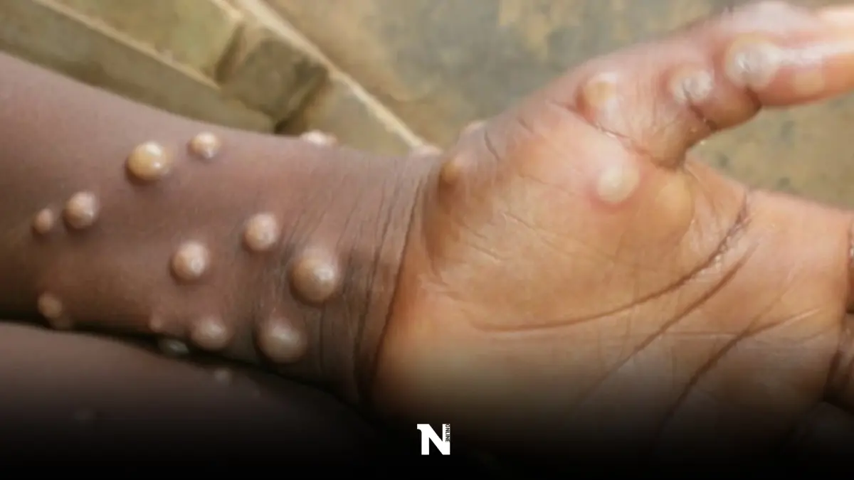 สหรัฐฯยืนยันพบผู้ป่วยฝีดาษลิงรายแรก หลังกลับจากแคนาดา สหรัฐฯยืนยันพบผู้ป่วยฝีดาษลิงรายแรก หลังกลับจากแคนาดา