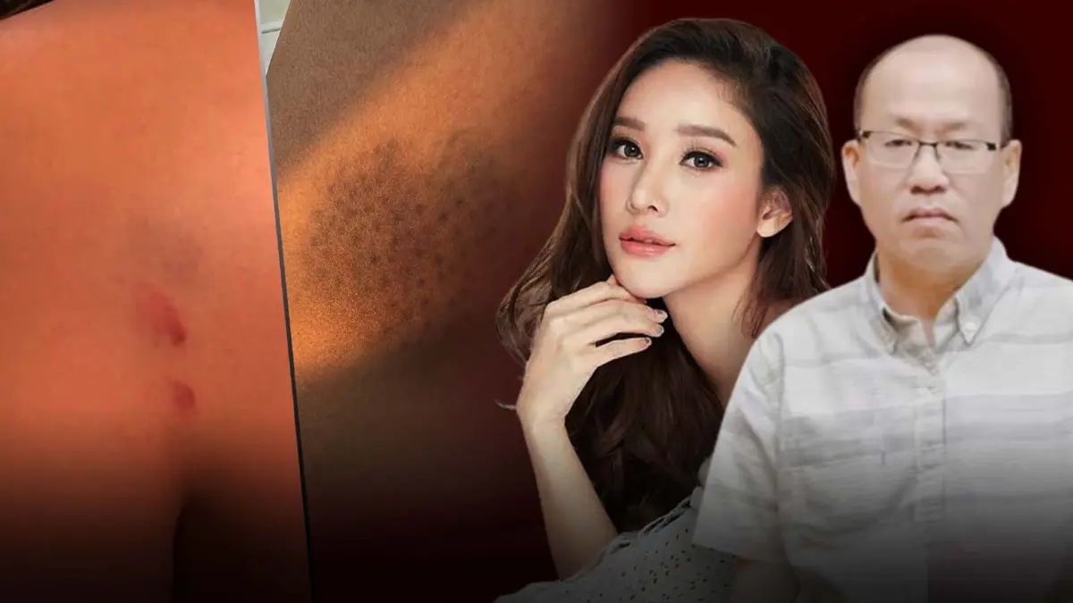โซเชียลกังขาเพจ "แตงโม" ปล่อยหลักฐาน-"อัจฉริยะ" ยันภาพรอยช้ำของเก่า