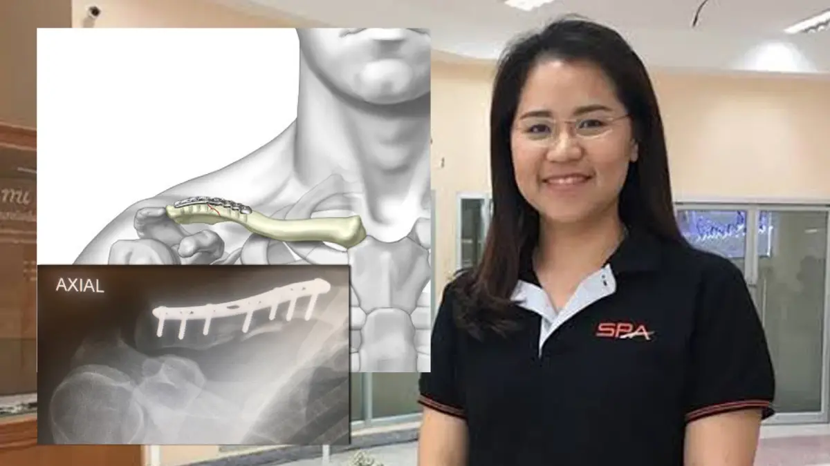 ผลงานวิจัยเสริมแข็งแรง ‘แผ่นดามกระดูกไหปลาร้า’