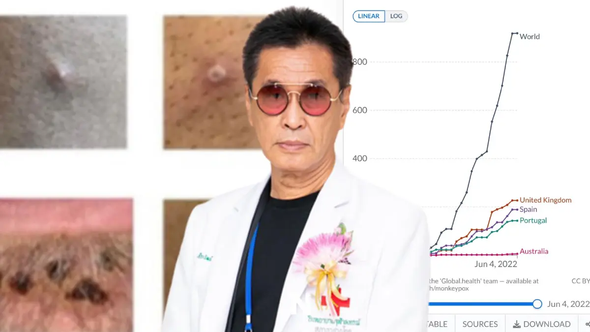 รู้เท่าทัน "ฝีดาษลิง" หมอธีระวัฒน์เปิด 9 ข้อ สถานการณ์ล่าสุด อาการต้องสงสัย