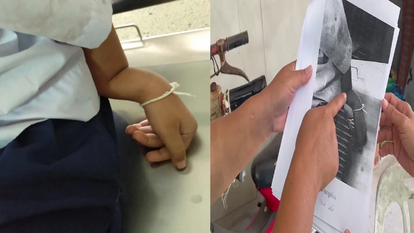 อาช็อคหลาน 5 ขวบแขนหักกลับบ้านครูไม่สนเบี้ยวค่าเยียวยา