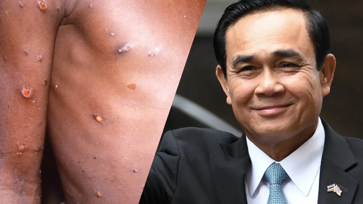 นายก ฯ เตือนประชาชนอย่ากังวล “ฝีดาษวานร” ไม่ติดต่อง่าย นายก ฯ เตือนประชาชนอย่ากังวล “ฝีดาษวานร” ไม่ติดต่อง่าย
