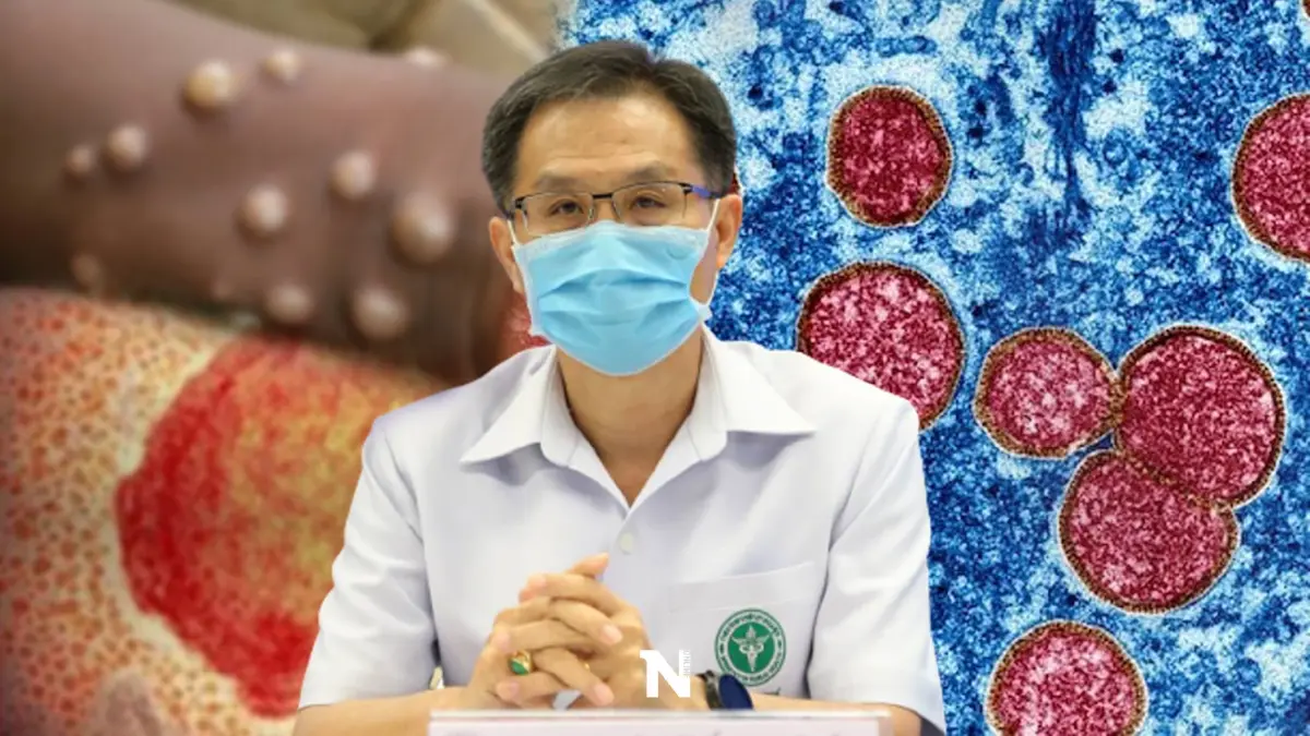 กรมการแพทย์ เปิดแนวทางรักษา “ฝีดาษลิง” ผู้ป่วยเข้าข่าย รพ.ต้องรับไว้ทุกราย