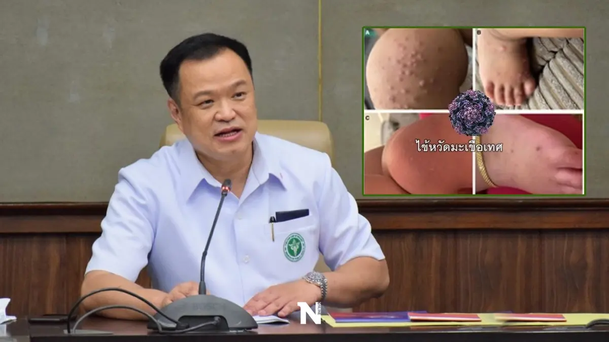 สธ. จับตา“ไข้หวัดมะเขือเทศ” หลังระบาดในหลายประเทศ ผู้ป่วยส่วนใหญ่เป็นเด็ก