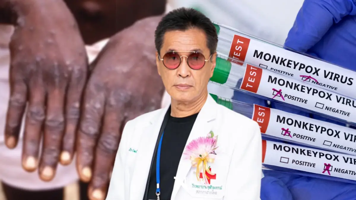 "หมอดื้อ" อัปเดต 9 ข้อ "ฝีดาษลิง" ยุค 2022 อาการแบบไหน ป้องกันอย่างไร?