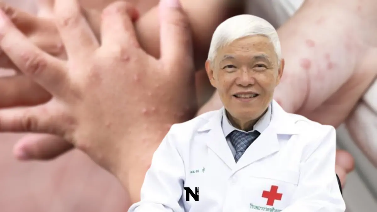 เตือน“โรคมือเท้าปาก” หมอยง ชี้สายพันธุ์อันตราย EV-A71 ทำป่วย"สมองอักเสบ"
