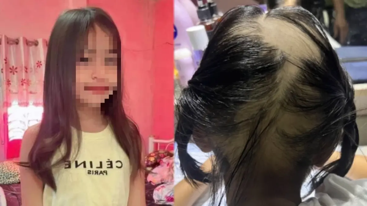 ทุกข์มาก แม่ร้องช่วย "เด็ก 9 ขวบ" ผมร่วมเกือบทั้งหัว หลังฉีดวัคซีนโควิดเข็ม 2 ทุกข์มาก แม่ร้องช่วย "เด็ก 9 ขวบ" ผมร่วมเกือบทั้งหัว หลังฉีดวัคซีนโควิดเข็ม 2