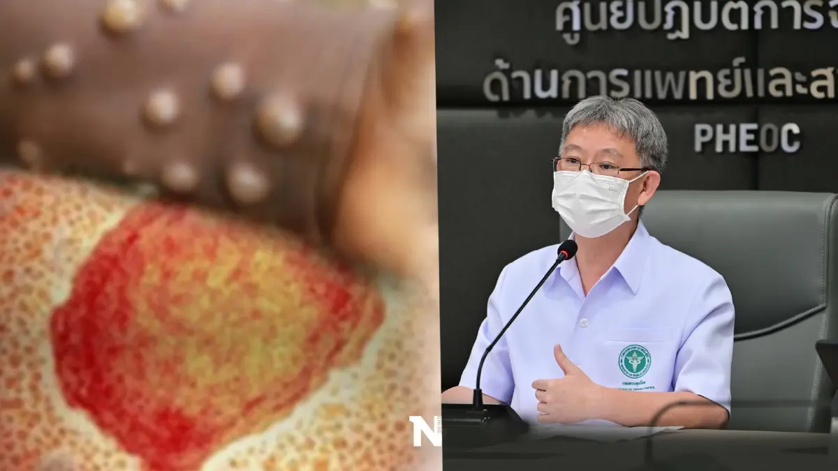 ด่วน! พบผู้ป่วย "ฝีดาษลิง" เพิ่ม 2 ราย ที่ภูเก็ต