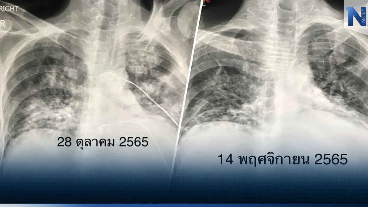 แพทย์ดังยกเคส วัคซีนโควิด ช่วยชีวิตคนเป็นมะเร็งเม็ดเลือดขาว กลุ่ม 608 รีบฉีดวัคซีนด่วน แพทย์ดังยกเคส วัคซีนโควิด ช่วยชีวิตคนเป็นมะเร็งเม็ดเลือดขาว กลุ่ม 608 รีบฉีดวัคซีนด่วน