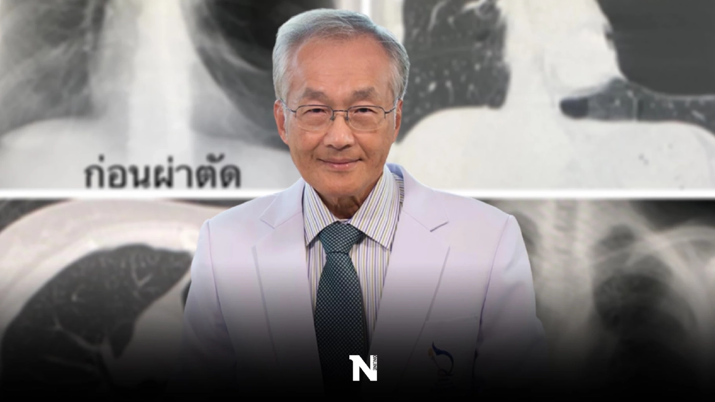 "ถุงลมโป่งพอง" ไม่สูบก็เป็นได้ หมอ ยกเคส เจอถุงลมใหญ่ ผิดปกติอย่างน้อย 20 ปี "ถุงลมโป่งพอง" ไม่สูบก็เป็นได้ หมอ ยกเคส เจอถุงลมใหญ่ ผิดปกติอย่างน้อย 20 ปี