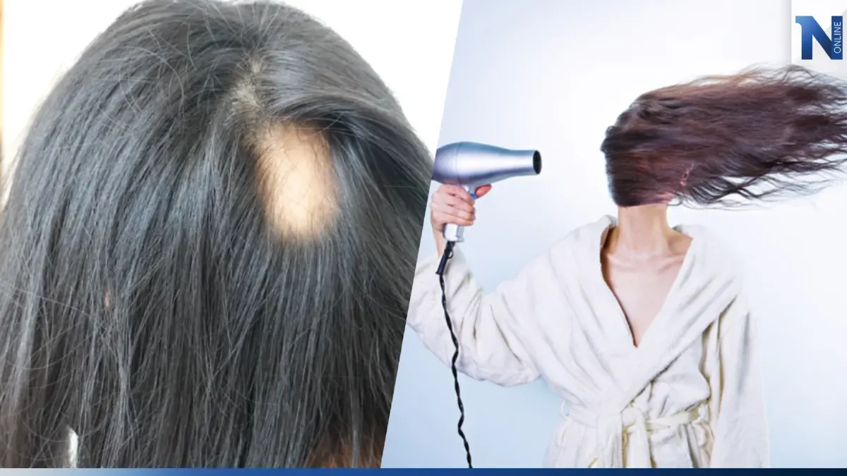 “ภาวะความเครียด” กับ “โรคผมร่วงเป็นหย่อม” หลายคนอาจเป็นโดยไม่รู้ตัว