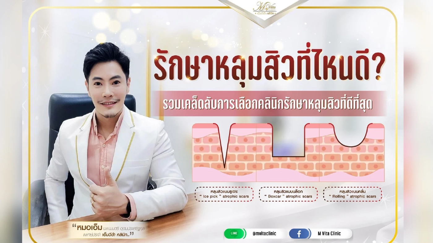 รักษาหลุมสิวที่ไหนดี? รวมเคล็ดลับการเลือกคลินิกรักษาหลุมสิวที่ดีที่สุด