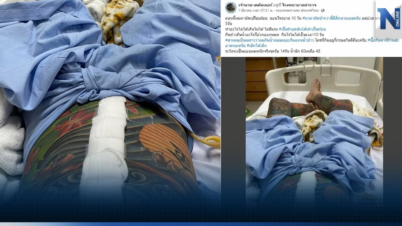โซเชียลแห่แชร์ หนุ่มเฉียดดับ ปวดท้องหนัก 5 วัน เจอไส้เน่า รีบผ่าตัดช่วยชีวิต