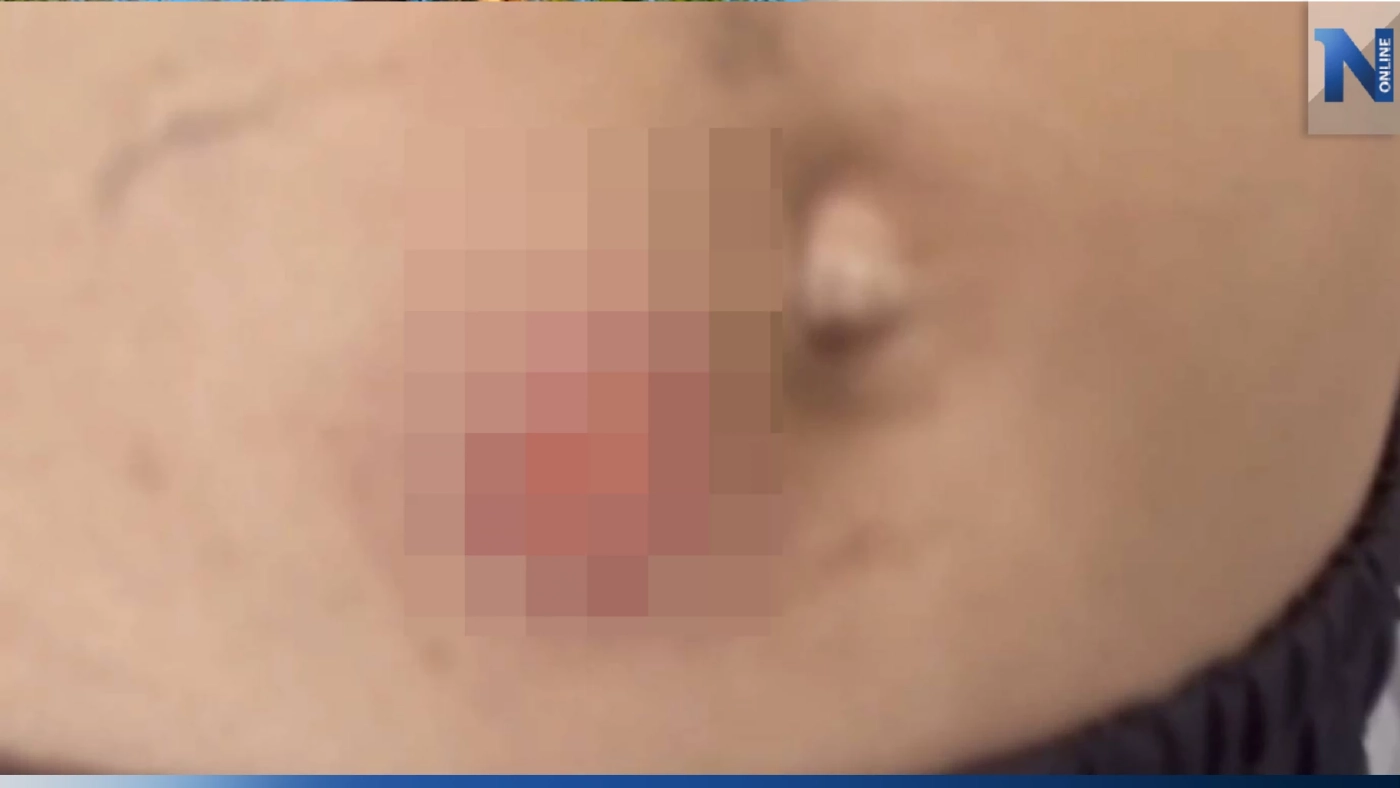 ลงโทษโหด! แม่ร้องสื่อ ลูก 10 ขวบ ถูกเพื่อนบ้านใช้ถ่านไฟแดง ๆ จี้สะดือทำโทษ