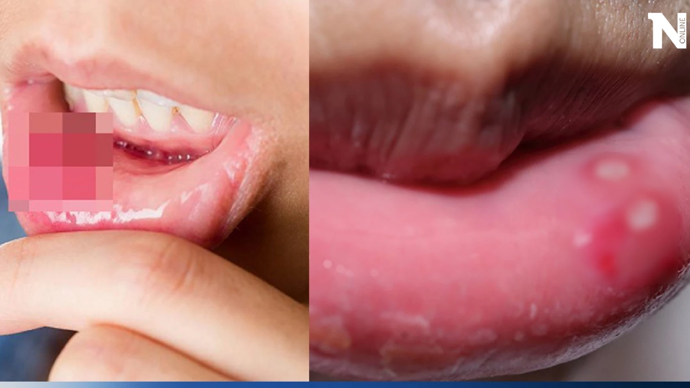 แพทย์เตือน มะเร็งช่องปาก เผยปัจจัยเสี่ยงที่จะเกิด มีอาการต้องรีบพบแพทย์