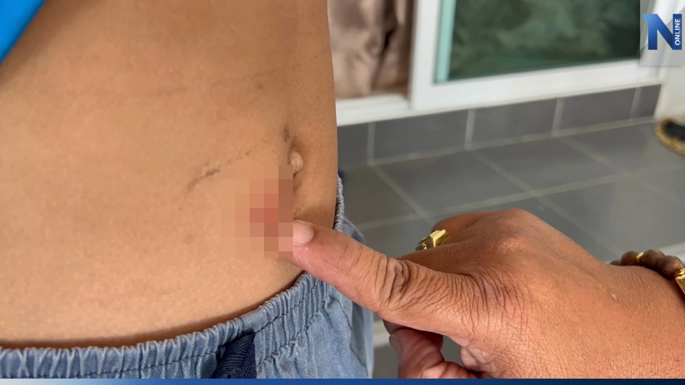 ตร.ล็อกตัวสอบสาวร้านชำ ใช้ถ่านร้อนจี้สะดือเด็กทำโทษ หลังเบี้ยวไม่ยอมมาพบ