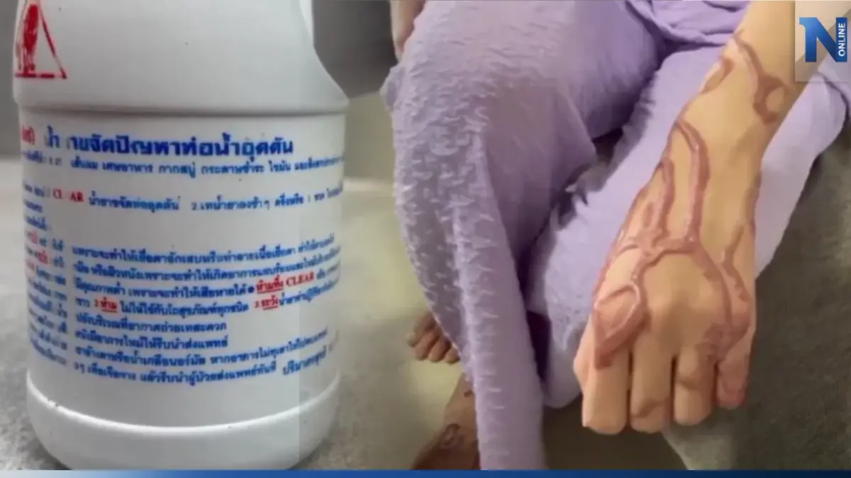สาวเตือนภัย ถูก "โซดาไฟ" ราดตัว นอน รพ.รักษานาน 2 เดือน ค่ารักษาเฉียด 2 ล้าน สาวเตือนภัย ถูก "โซดาไฟ" ราดตัว นอน รพ.รักษานาน 2 เดือน ค่ารักษาเฉียด 2 ล้าน