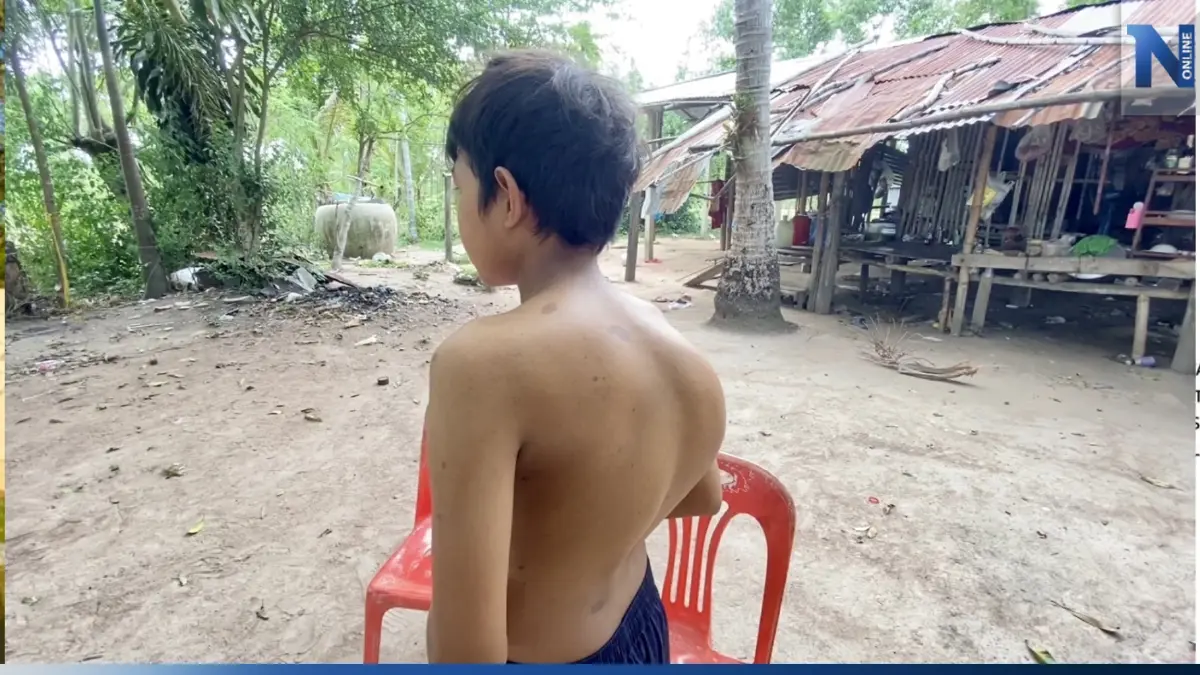 วอนช่วยด่วน เด็กวัย 15 หลังคดตาใกล้บอด ไร้เงินรักษา ถ้าไม่ผ่าอยู่ได้แค่ 3 ปี