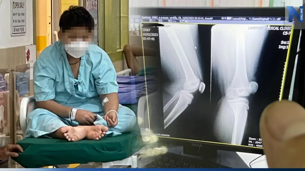 พ่อลำพูนสุดช้ำ! ลูกชายวัย 12 โดนครูสั่งลงโทษลุกนั่ง 150 ครั้ง จนกระดูกหัก