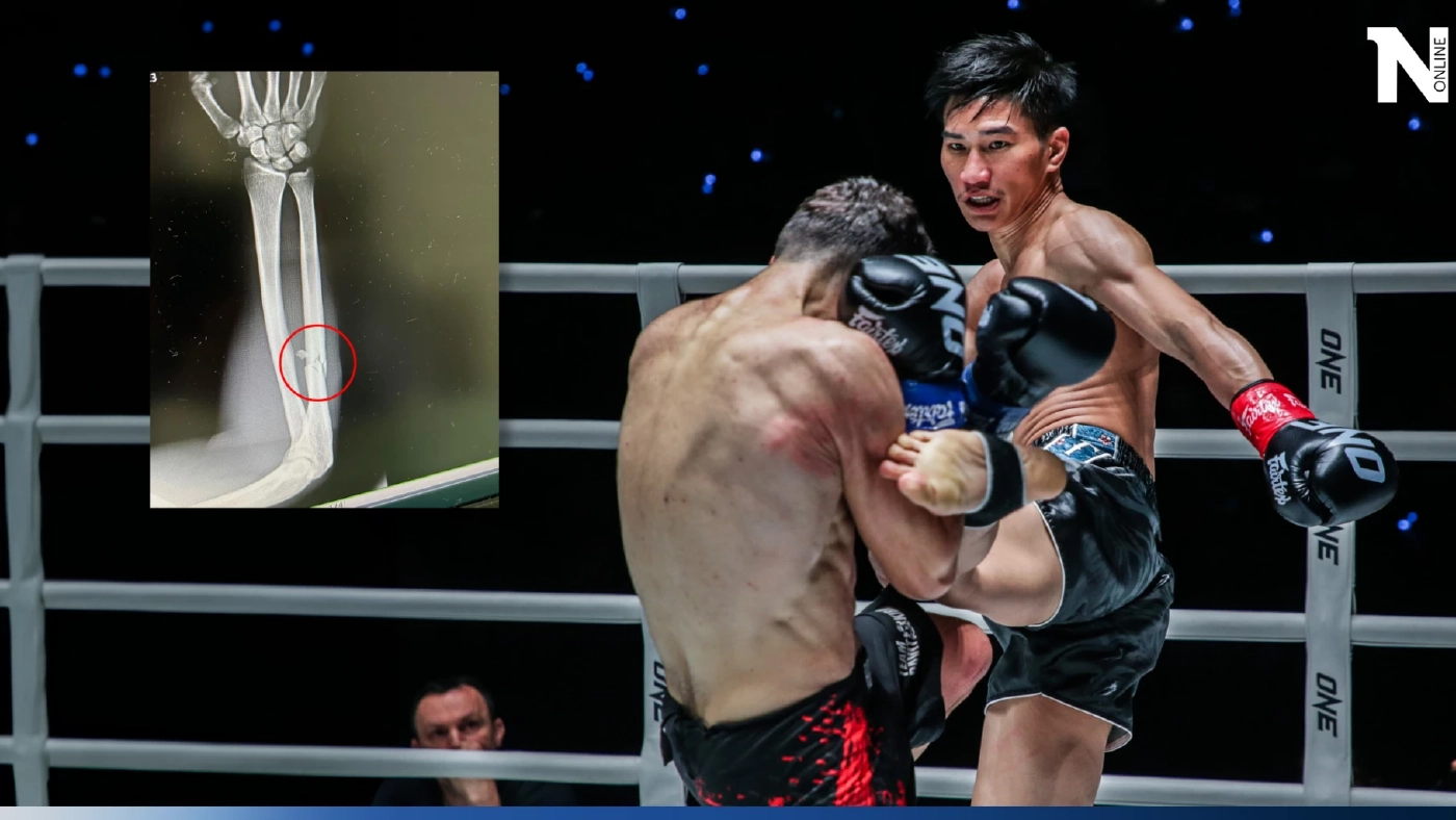 เผยภาพเอ็กซ์เรย์ "ดาวิต คิเรีย" หลังโดนลูกเตะ "ตะวันฉาย" ทำพ่าย TKO