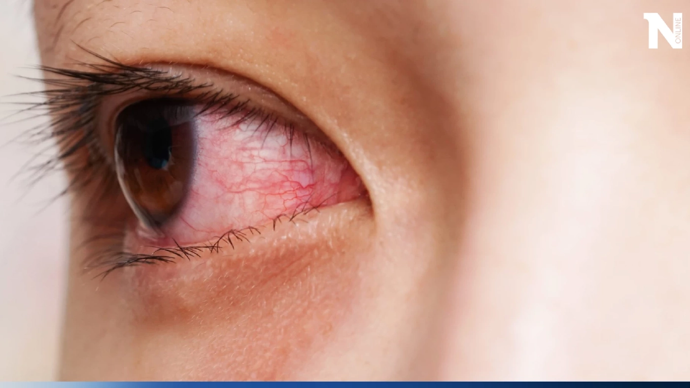 เปิดวิธีป้องกัน "ตาแดง" หนึ่งโรคระบาดที่คนไทย ควระวังในช่วงหน้าฝนนี้ เปิดวิธีป้องกัน "ตาแดง" หนึ่งโรคระบาดที่คนไทย ควระวังในช่วงหน้าฝนนี้