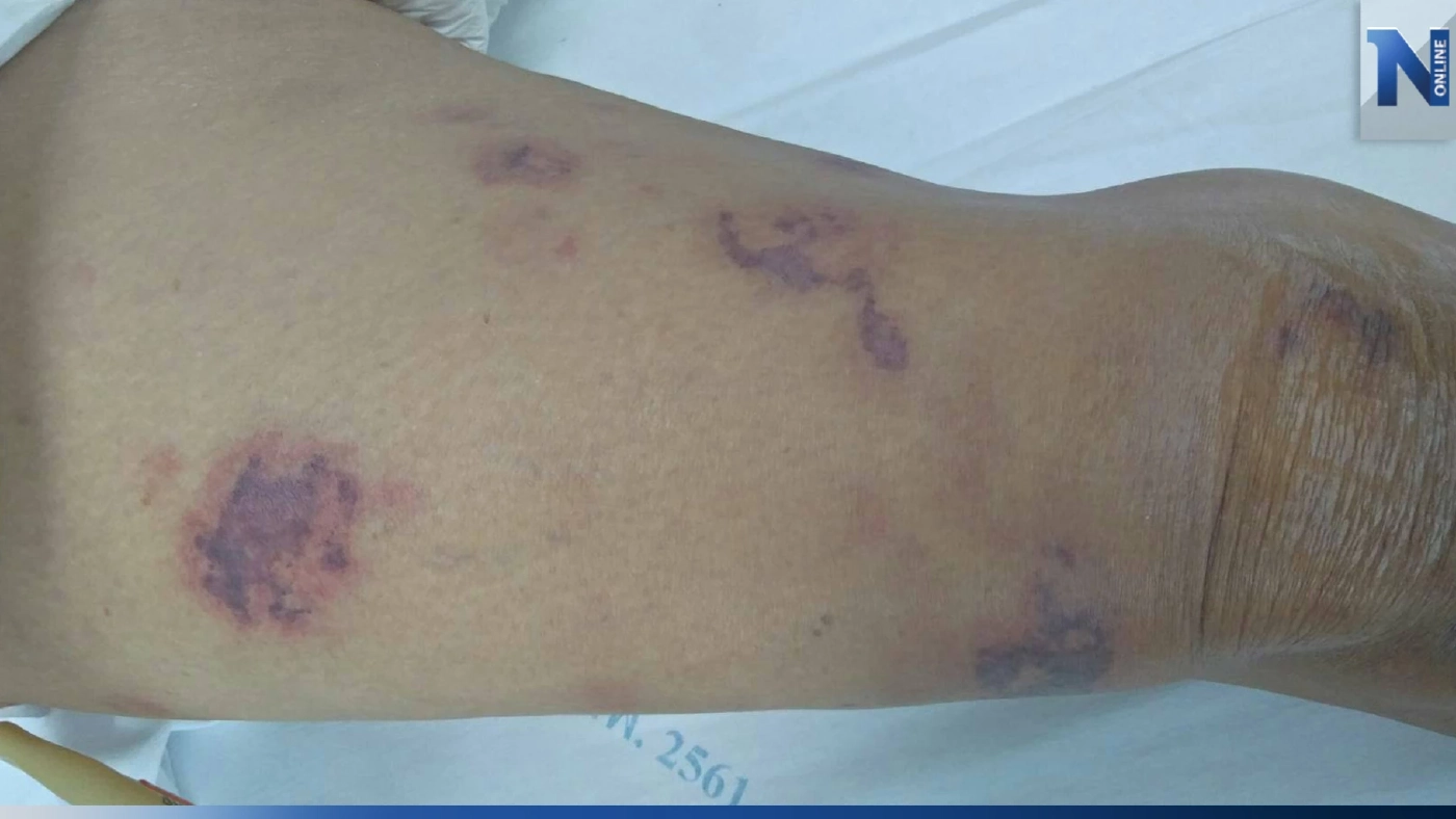 เปิดความจริง"แบคทีเรียกินเนื้อ" ร้ายแค่ไหน คร่าชีวิตแล้ว 2 รายจริงหรือไม่