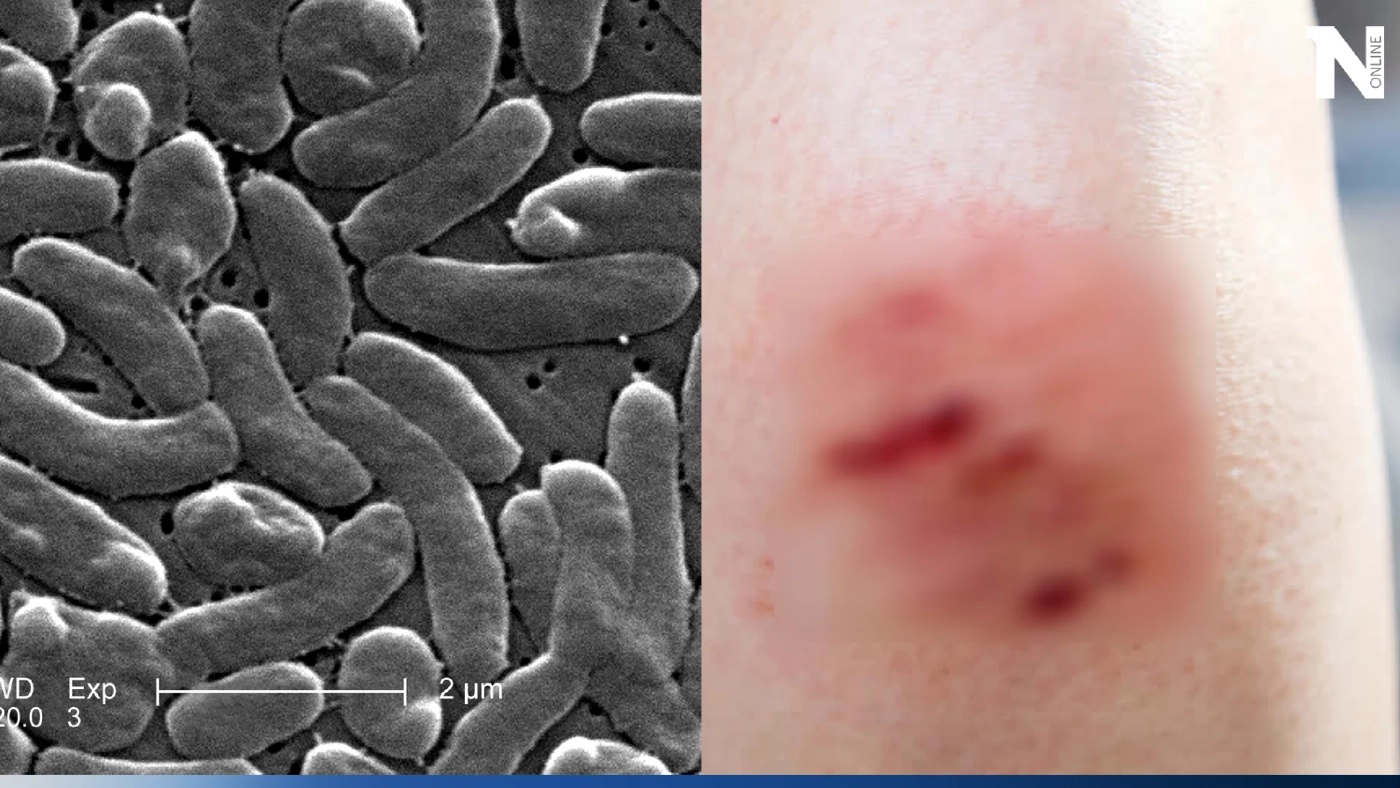 แบคทีเรียกินเนื้อเพิ่มขึ้น เหตุจากโลกร้อน เตือนมีแผลไม่ควรเล่นน้ำทะเล