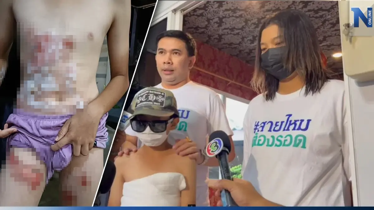 ร้องเพจสายไหมฯ น้อง ป.5 ถูกรุ่นพี่ ม.2 ราดแอลกอฮอล์ จุดไฟเผา