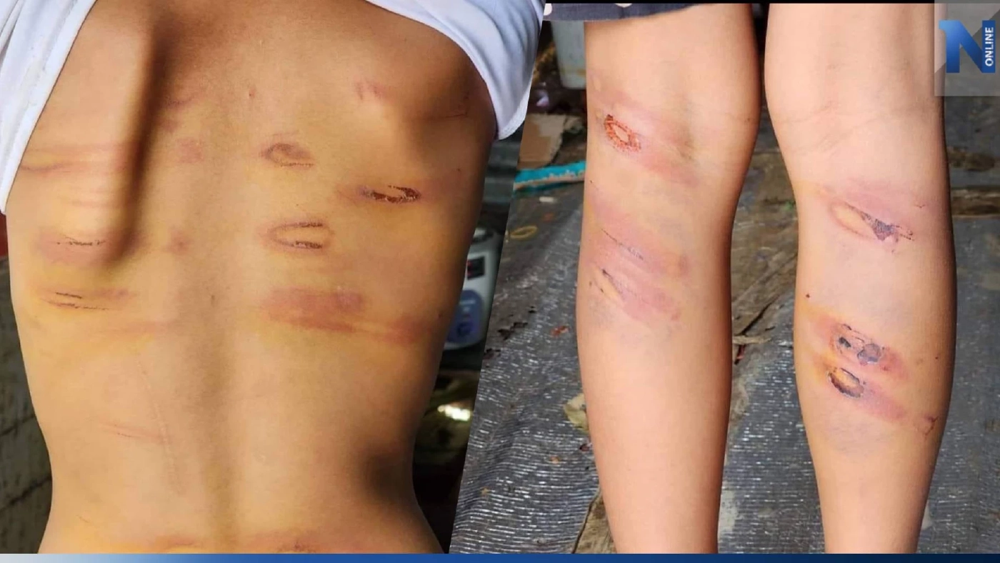 สุดทน พ่อหลอนยา ตีลูกจนเป็นแผลทั่วร่าง สุดทน พ่อหลอนยา ตีลูกจนเป็นแผลทั่วร่าง