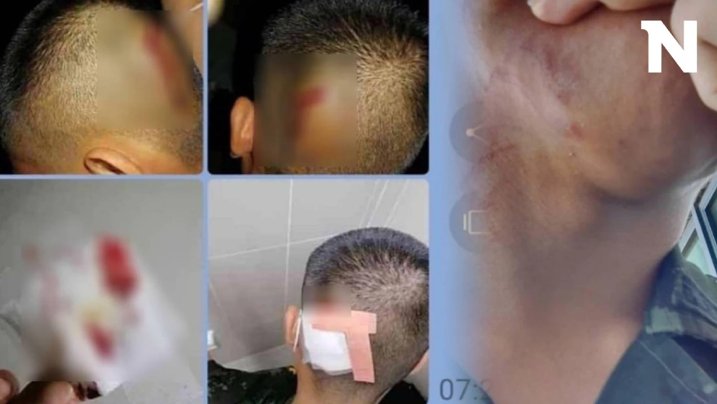 อีกแล้ว! แม่ทหารเกณฑ์ ร้องเพจดัง "ครูฝึกทหาร" ทำร้ายลูกชายบาดเจ็บ