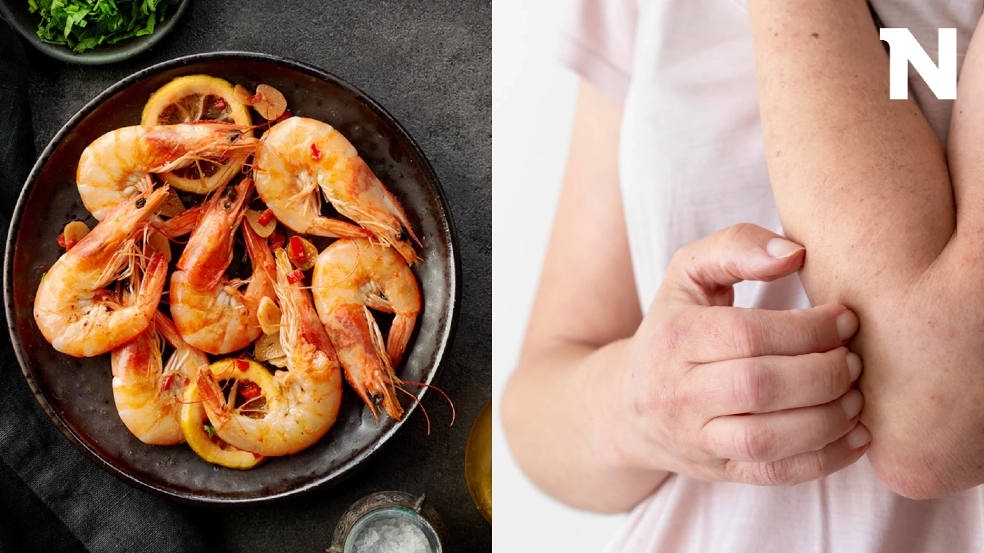 ไขข้อข้องใจ ทำไม? บางทีกินกุ้งไม่แพ้ แต่บางครั้งก็แพ้ เป็นเพราะอะไร?