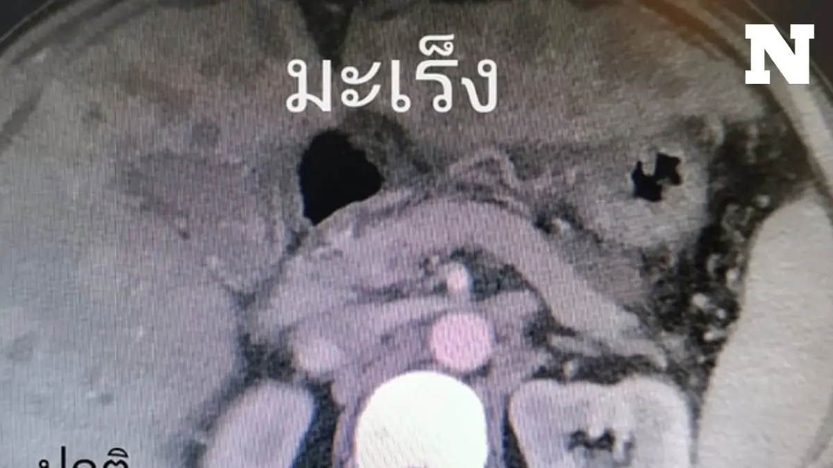 คนไข้อายุ 37 ปี ออกกำลังกาย-ไม่ดื่มเหล้า แต่ป่วยมะเร็งตับ หมอแนะหมั่นตรวจสุขภาพ