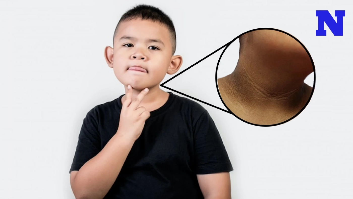 “ปื้นดำที่คอ” อาจไม่ใช่แค่ขี้ไคล แต่เป็นสัญญาณเตือน “โรคเบาหวานในเด็ก”