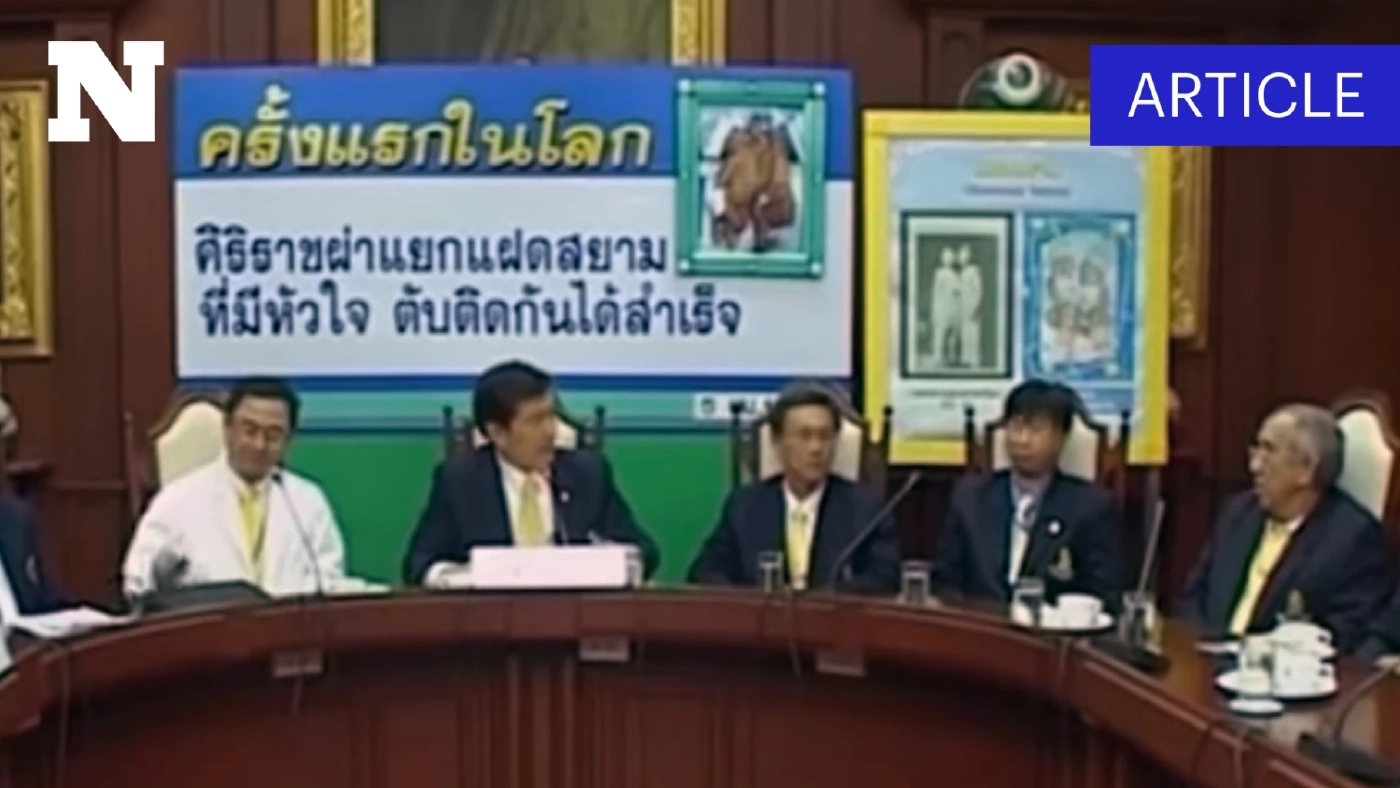 วันนี้เมื่อปี 2550 หมอศิริราช ผ่าตัด "แฝดสยาม" หัวใจติดกัน รอดชีวิตทั้งคู่ ครั้งแรกของโลก