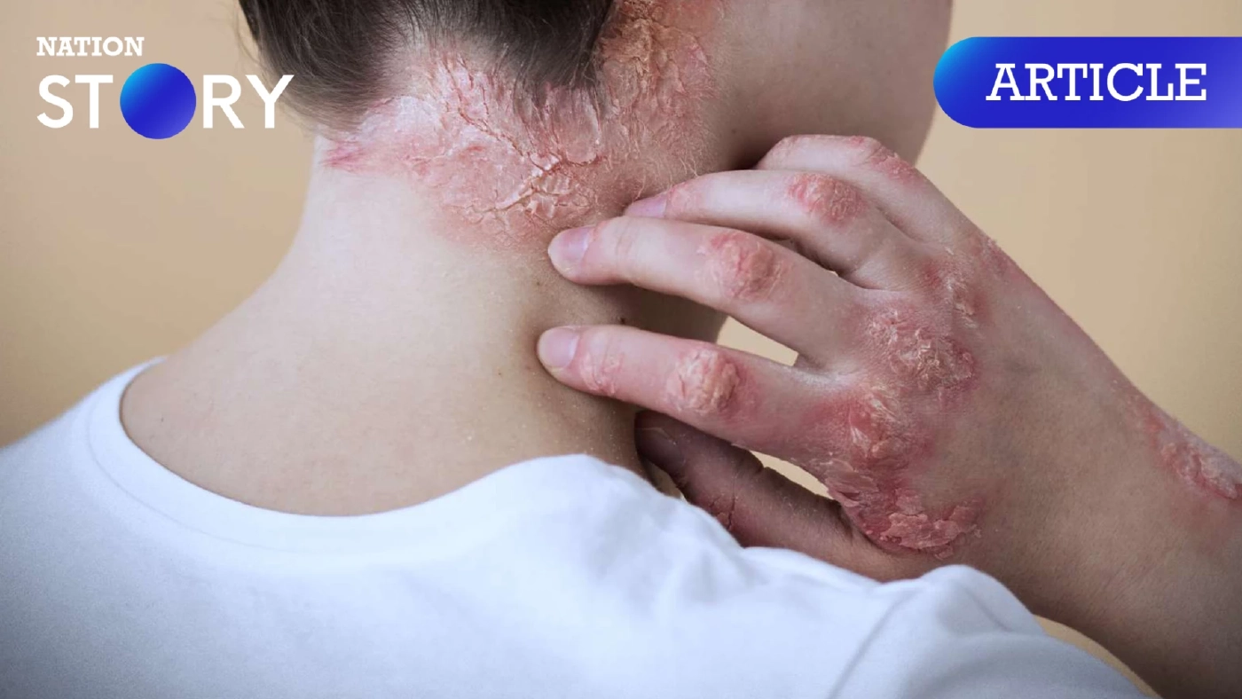 รู้จัก Bullous Pemphigoid โรคตุ่มน้ำพอง และภาวะติดเชื้อในกระแสเลือด