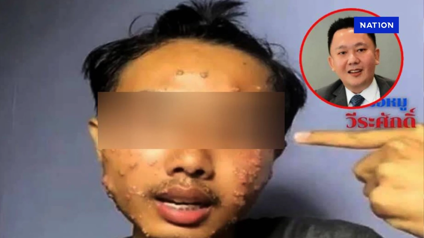 เตือน! "หมอหมู" ระบุุติดเชื้อผิวหนังรุนแรง หากสวมเสื้อผ้ามือสองที่ยังไม่ซัก