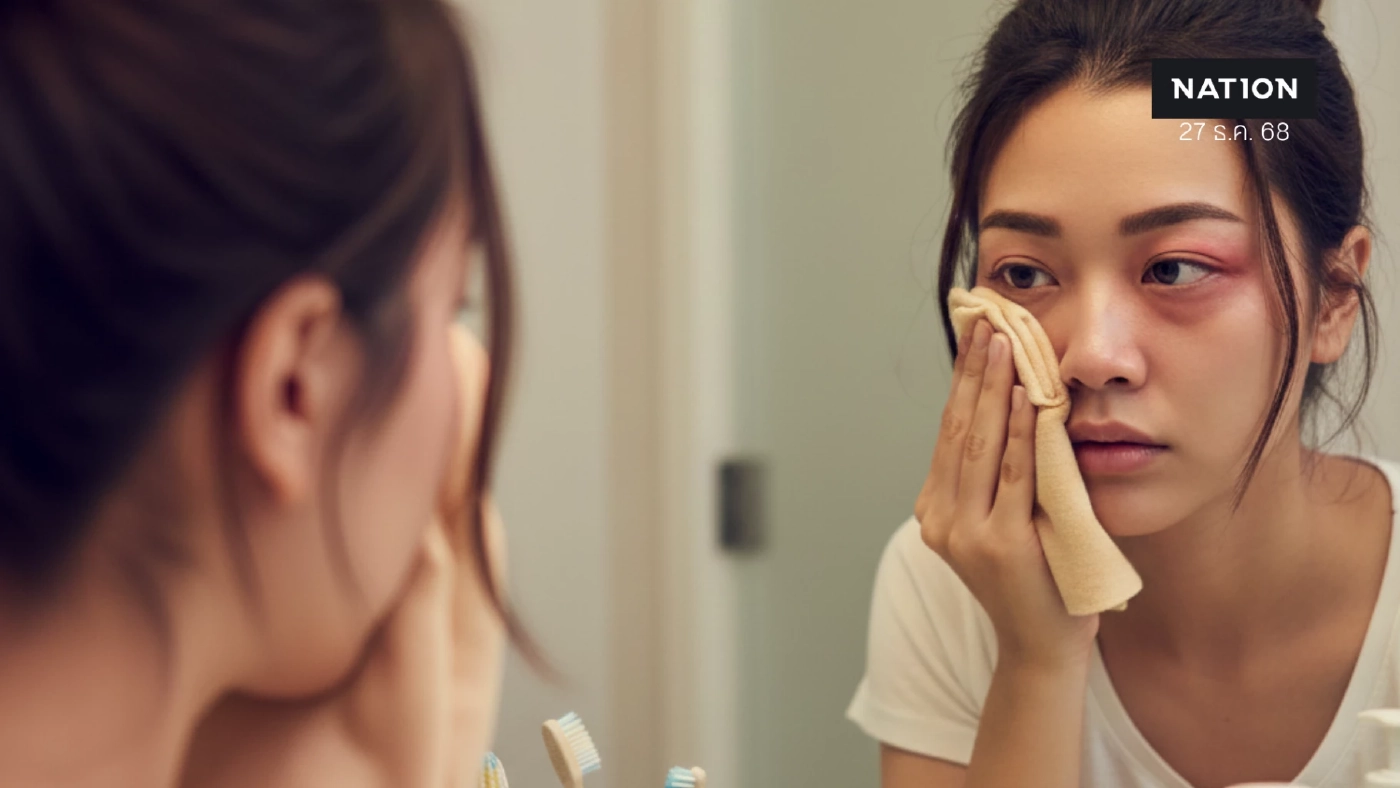 ตากุ้งยิงไม่ใช่โรคติดต่อ! เช็กสาเหตุ-วิธีดูแลให้หายไว ตากุ้งยิงไม่ใช่โรคติดต่อ! เช็กสาเหตุ-วิธีดูแลให้หายไว