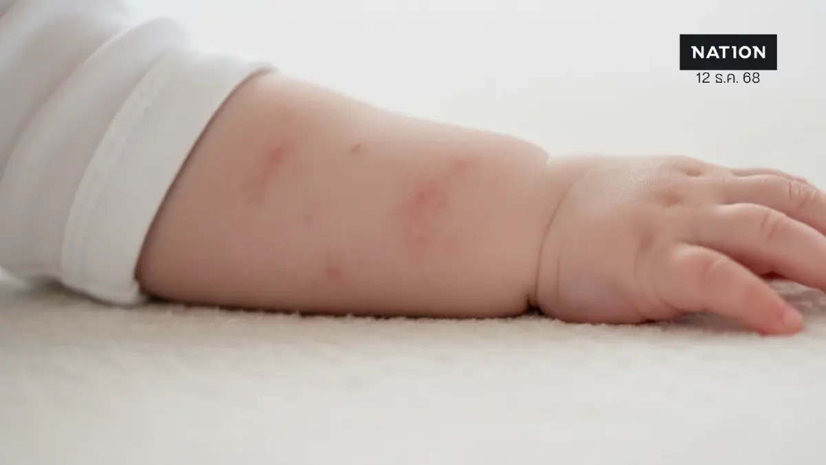ผิวลูกน้อยแพ้ง่ายในช่วงหน้าหนาว พ่อแม่ควรดูแลอย่างไร