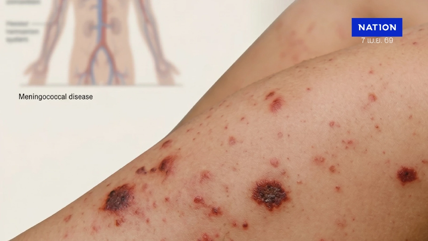 อันตรายถึงชีวิตใน 24 ชม.! รู้จัก "กาฬหลังแอ่น" ภัยร้ายที่พ่อแม่ต้องระวัง