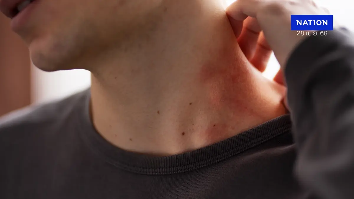 ฝุ่น PM 2.5 ภัยเงียบทำร้าย “ผิวหนัง” มากกว่าที่คิด แพทย์เตือนเสี่ยงผื่น-เร่งผิวแก่ก่อนวัย